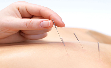 Acupuncture treatment